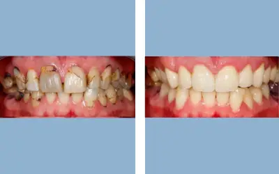 Before and After